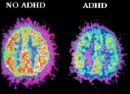 ADHD attention deficit hyperactivity diagnosis